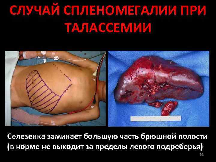 СЛУЧАЙ СПЛЕНОМЕГАЛИИ ПРИ ТАЛАССЕМИИ Селезенка заминает большую часть брюшной полости (в норме не выходит