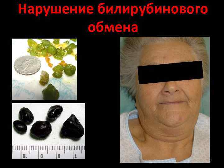 Нарушение билирубинового обмена 55 