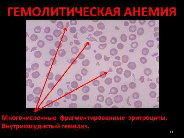 Гемолитическая анемия картина крови