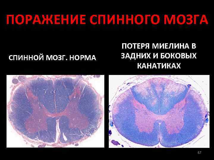 ПОРАЖЕНИЕ СПИННОГО МОЗГА СПИННОЙ МОЗГ. НОРМА ПОТЕРЯ МИЕЛИНА В ЗАДНИХ И БОКОВЫХ КАНАТИКАХ 67