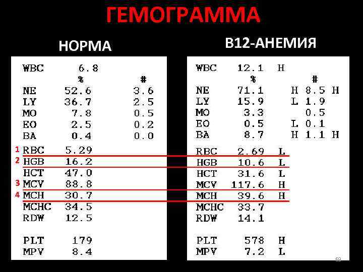 Гемограмма. Гемограмма при анемии б12. В12 дефицитная анемия гемограмма. Гемограмма при б12 дефицитной. Изменение показателей гемограммы при анемиях.