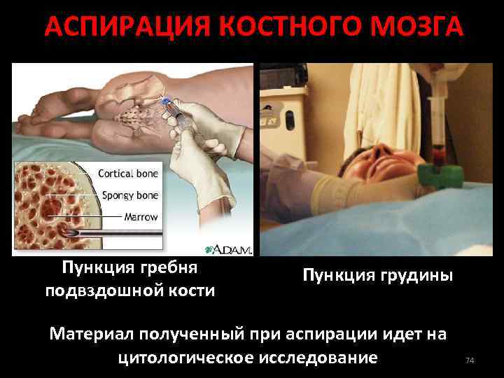 АСПИРАЦИЯ КОСТНОГО МОЗГА Пункция гребня подвздошной кости Пункция грудины Материал полученный при аспирации идет