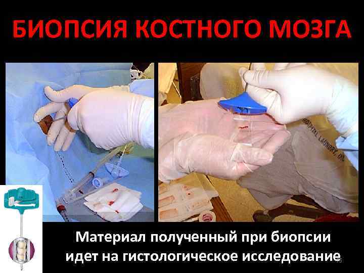 БИОПСИЯ КОСТНОГО МОЗГА Материал полученный при биопсии идет на гистологическое исследование 75 