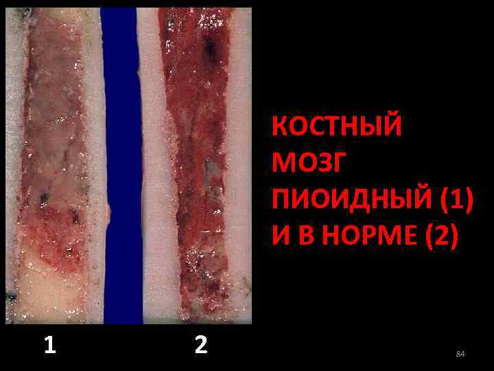 КОСТНЫЙ МОЗГ ПИОИДНЫЙ (1) И В НОРМЕ (2) 1 2 84 
