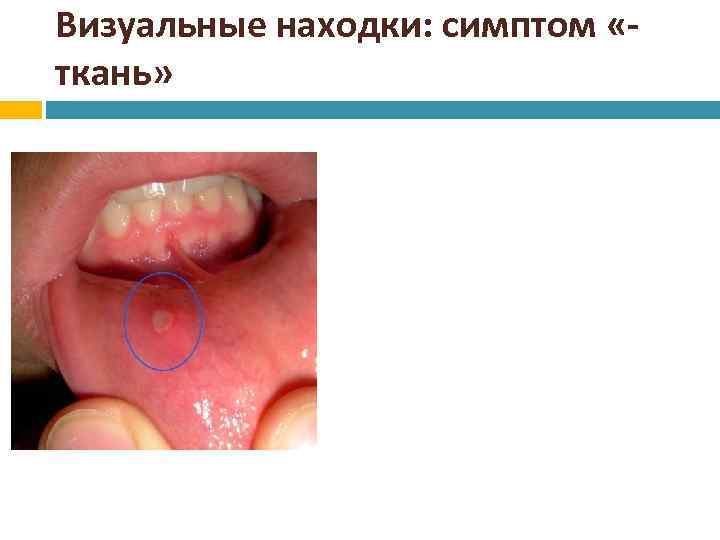 Визуальные находки: симптом «ткань» 