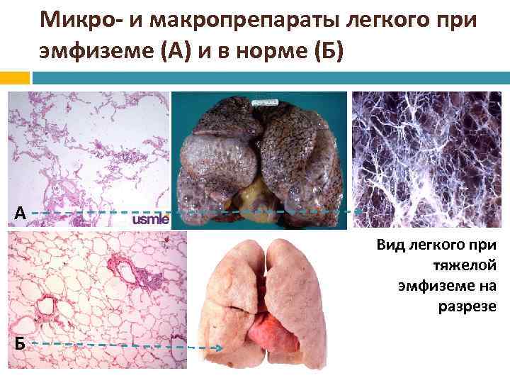 Микро- и макропрепараты легкого при эмфиземе (А) и в норме (Б) А Вид легкого