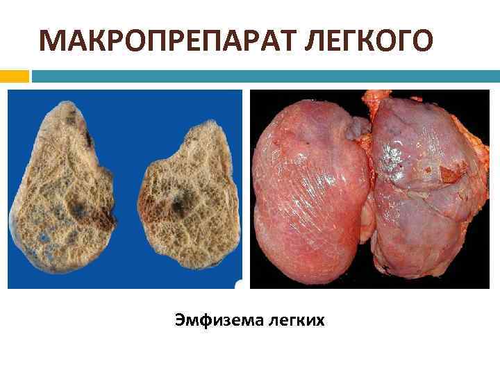 МАКРОПРЕПАРАТ ЛЕГКОГО Эмфизема легких 