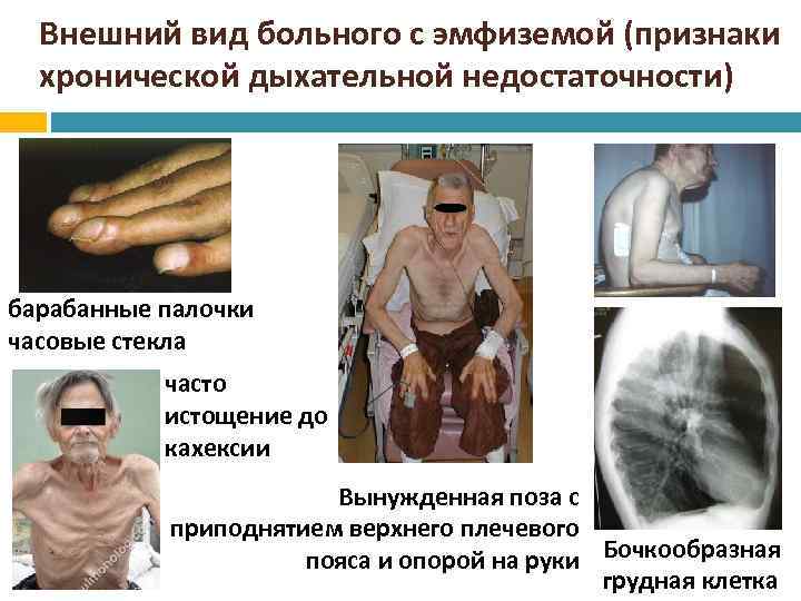Внешний вид больного с эмфиземой (признаки хронической дыхательной недостаточности) барабанные палочки часовые стекла часто