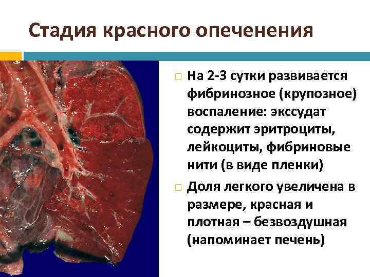 Нехарактерным для клинической картины неосложненного силикоза является