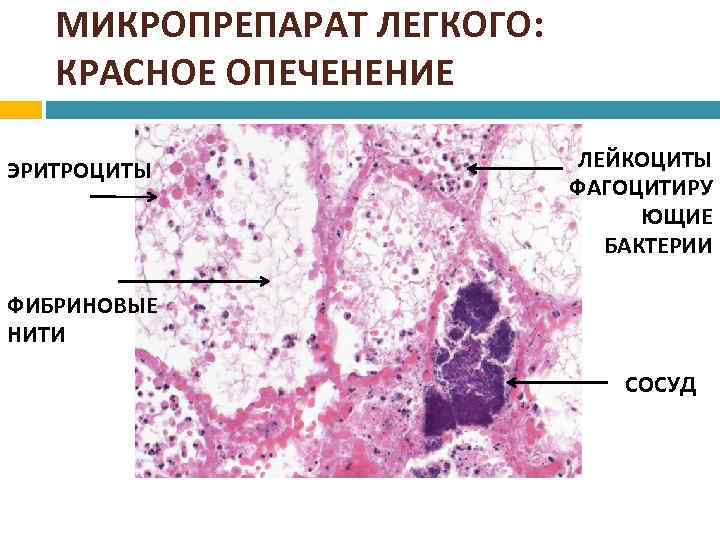 Крупозная пневмония патологическая анатомия презентация