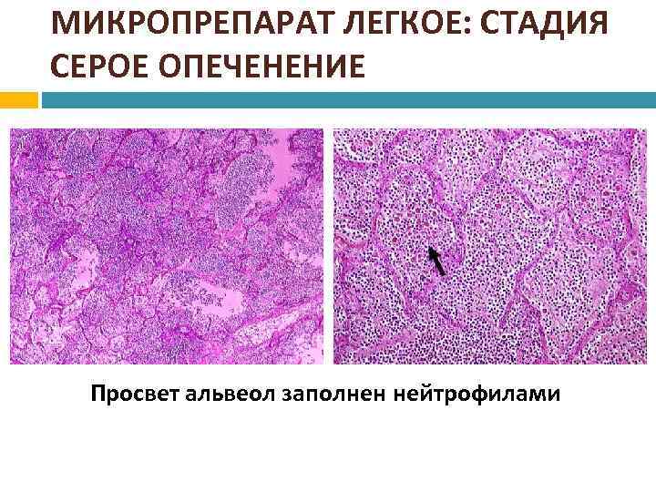 Пневмония микропрепарат описание. Крупозная пневмония макропрепарат. Лобарная пневмония микропрепарат. Крупозная пневмония красного опеченения микропрепарат. Крупозная пневмония стадия серого опеченения микропрепарат.