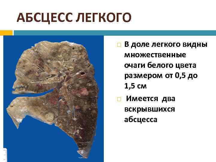 АБСЦЕСС ЛЕГКОГО В доле легкого видны множественные очаги белого цвета размером от 0, 5
