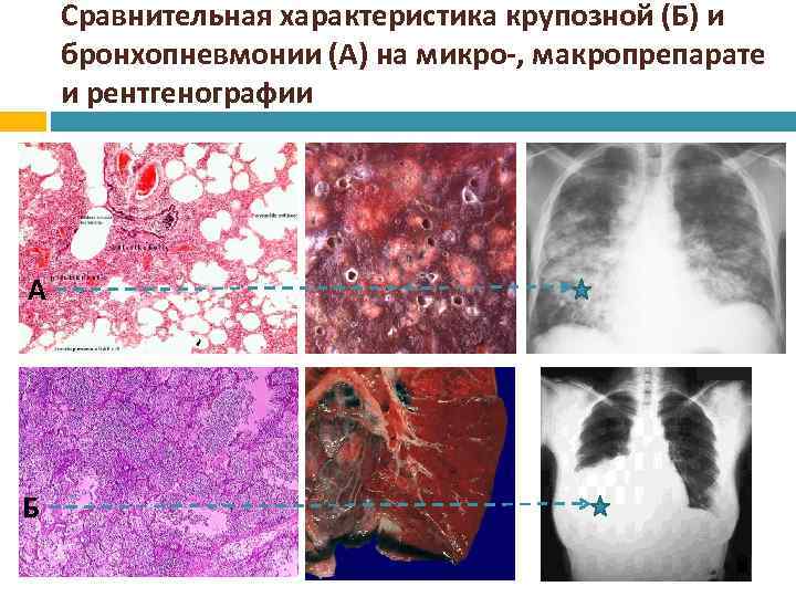 Бронхопневмония карта вызова