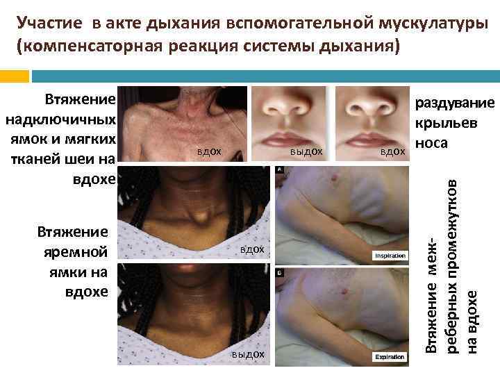 Участие в акте дыхания вспомогательной мускулатуры (компенсаторная реакция системы дыхания) Втяжение яремной ямки на