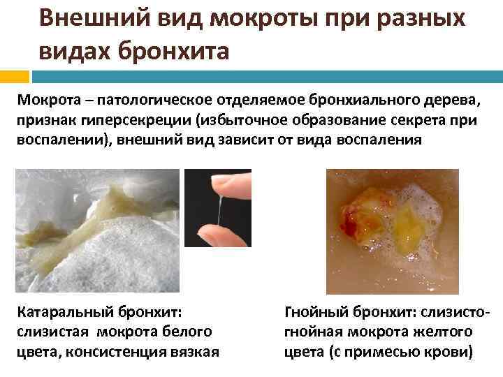 Внешний вид мокроты при разных видах бронхита Мокрота – патологическое отделяемое бронхиального дерева, признак
