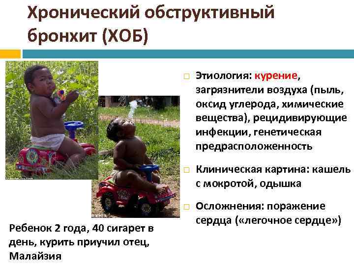 Хронический обструктивный бронхит (ХОБ) Ребенок 2 года, 40 сигарет в день, курить приучил отец,