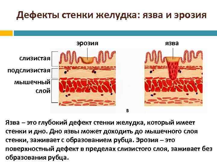 Дефекты стенки желудка: язва и эрозия язва слизистая подслизистая мышечный слой Язва – это