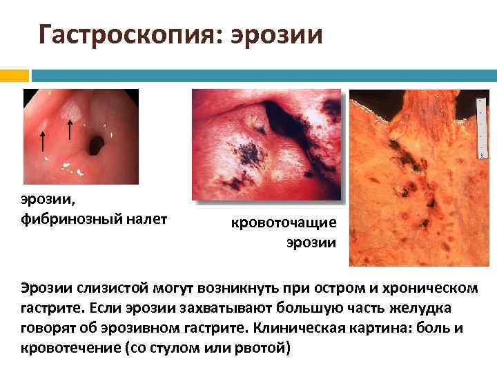 Гастроскопия: эрозии, фибринозный налет кровоточащие эрозии Эрозии слизистой могут возникнуть при остром и хроническом