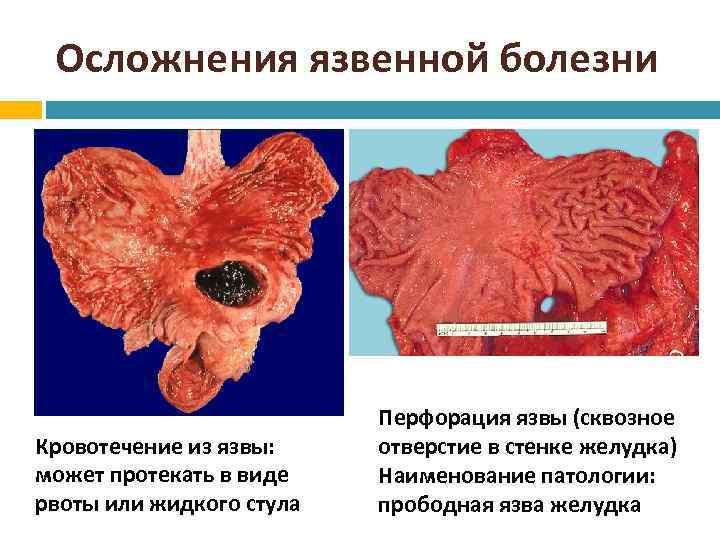 Осложнения язвенной болезни Кровотечение из язвы: может протекать в виде рвоты или жидкого стула