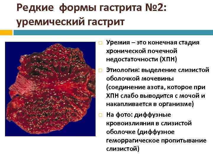 Редкие формы гастрита № 2: уремический гастрит Уремия – это конечная стадия хронической почечной