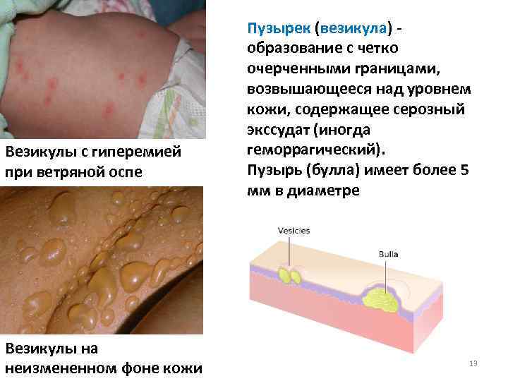 Везикулы с гиперемией при ветряной оспе Везикулы на неизмененном фоне кожи Пузырек (везикула) -