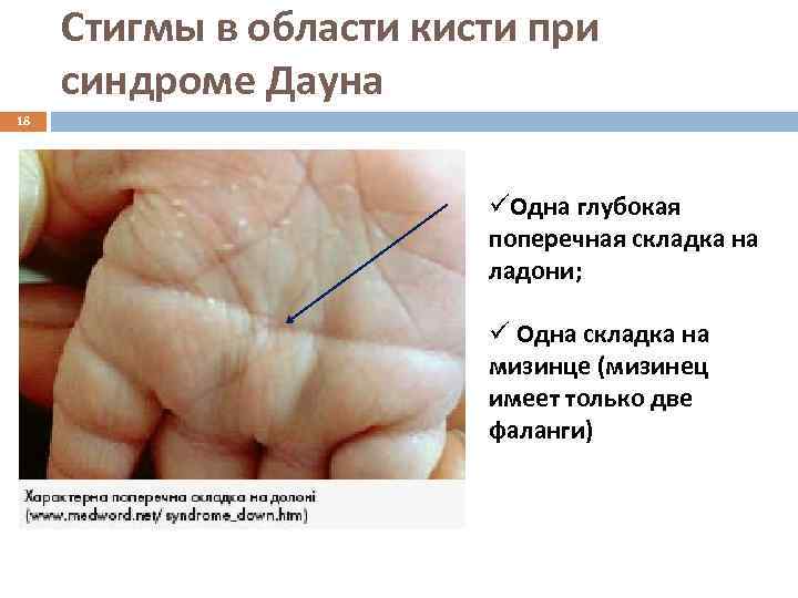 Стигмы в области кисти при синдроме Дауна 18 üОдна глубокая поперечная складка на ладони;