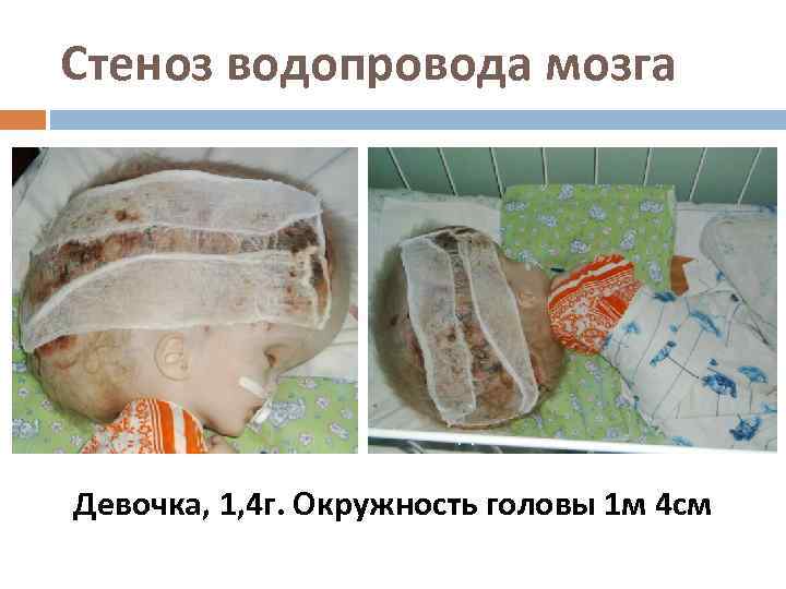 Стеноз водопровода мозга Девочка, 1, 4 г. Окружность головы 1 м 4 см 