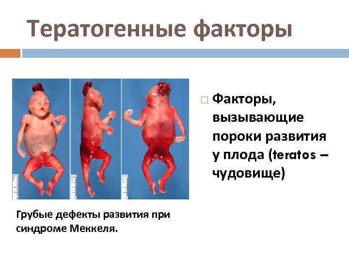 Тератогенные факторы Грубые дефекты развития при синдроме Меккеля. Факторы, вызывающие пороки развития у плода