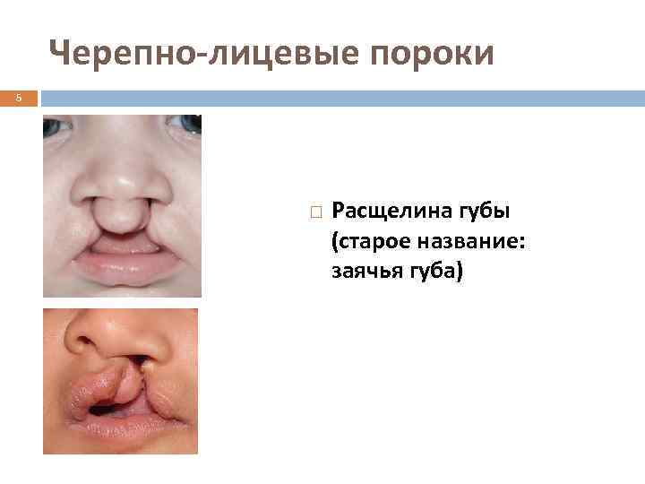 Черепно-лицевые пороки 5 Расщелина губы (старое название: заячья губа) 