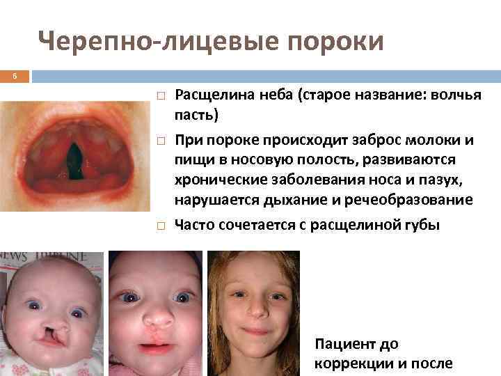 Черепно-лицевые пороки 6 Расщелина неба (старое название: волчья пасть) При пороке происходит заброс молоки