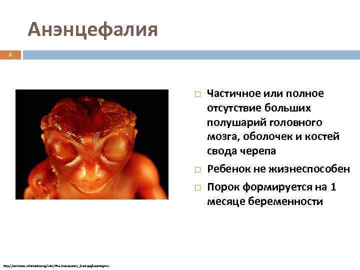 Анэнцефалия 8 http: //commons. wikimedia. org/wiki/File: Anencephaly_front. jpg? uselang=ru Частичное или полное отсутствие больших