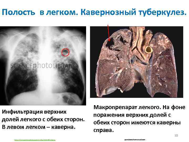 Полость в легком. Кавернозный туберкулез. Инфильтрация верхних долей легкого с обеих сторон. В левом
