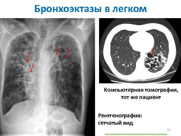 Бронхоэктазы в легком Компьютерная томография, тот же пациент Рентгенография: сетчатый вид 11 http: //www.