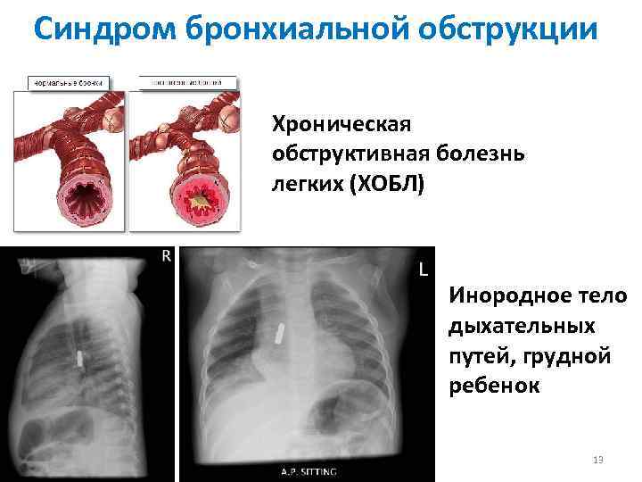 Хроническая обструктивная болезнь легких картинки