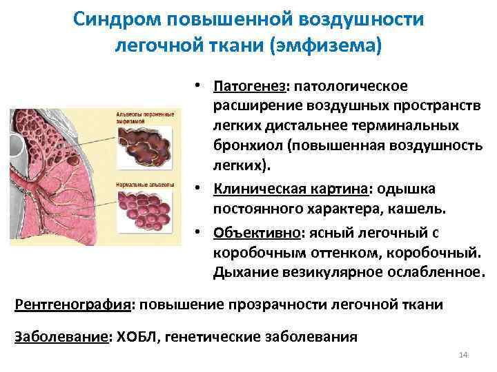 Синдром повышенной воздушности легочной ткани (эмфизема) • Патогенез: патологическое расширение воздушных пространств легких дистальнее