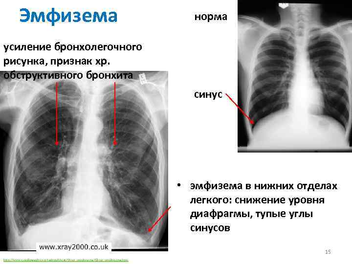 Эмфизема норма усиление бронхолегочного рисунка, признак хр. обструктивного бронхита синус • эмфизема в нижних