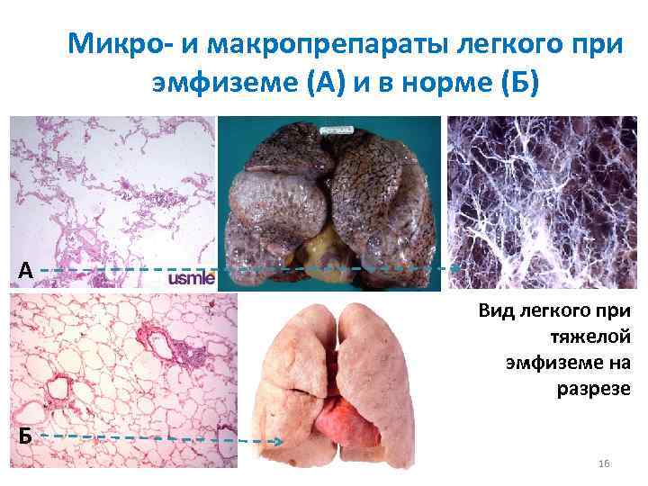 Микро- и макропрепараты легкого при эмфиземе (А) и в норме (Б) А Вид легкого