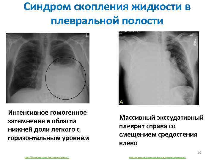 Синдром скопления жидкости в плевральной полости Интенсивное гомогенное затемнение в области нижней доли легкого