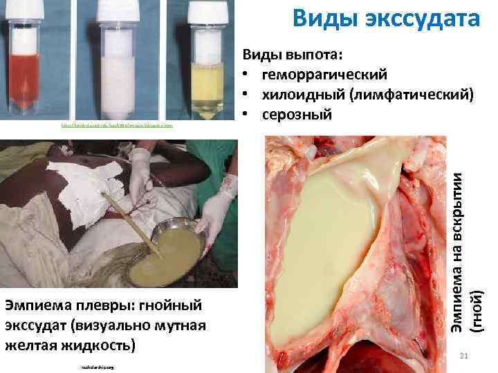 Виды экссудата Эмпиема плевры: гнойный экссудат (визуально мутная желтая жидкость) escholarship. org Эмпиема на