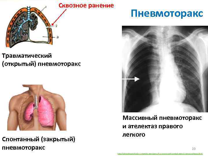 Сквозное ранение Пневмоторакс Травматический (открытый) пневмоторакс Спонтанный (закрытый) пневмоторакс Массивный пневмоторакс и ателектаз правого