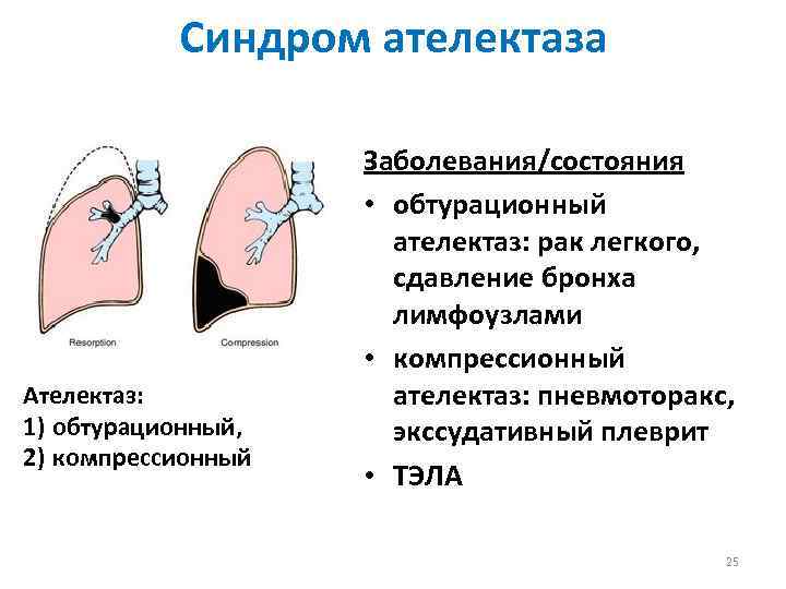 Синдром ателектаза Ателектаз: 1) обтурационный, 2) компрессионный Заболевания/состояния • обтурационный ателектаз: рак легкого, сдавление