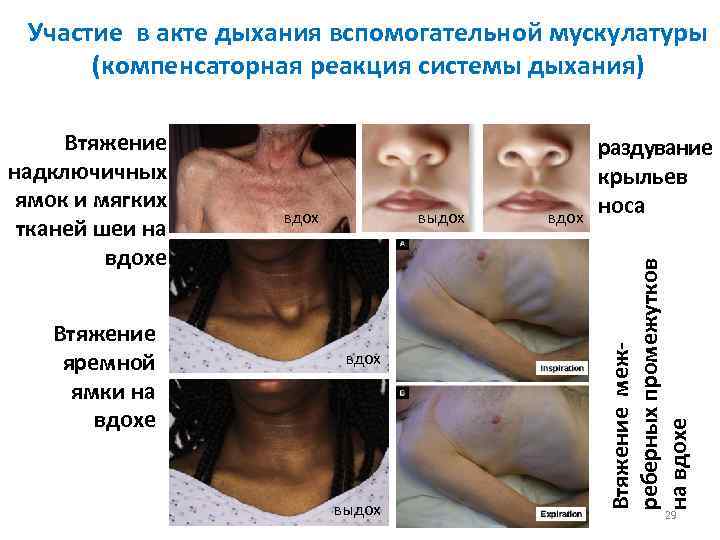 Участие в акте дыхания вспомогательной мускулатуры (компенсаторная реакция системы дыхания) Втяжение яремной ямки на