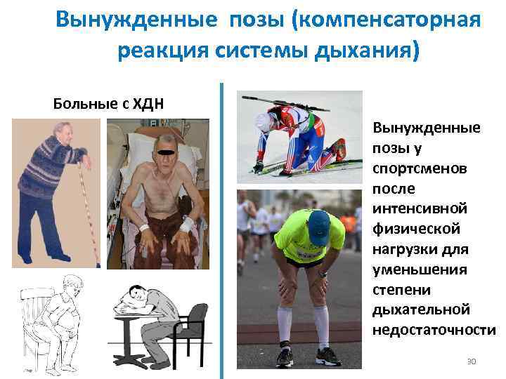 Вынужденные позы (компенсаторная реакция системы дыхания) Больные с ХДН Вынужденные позы у спортсменов после