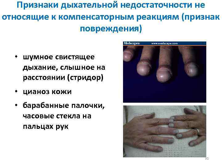 Признаки дыхательной недостаточности не относящие к компенсаторным реакциям (признак повреждения) • шумное свистящее дыхание,