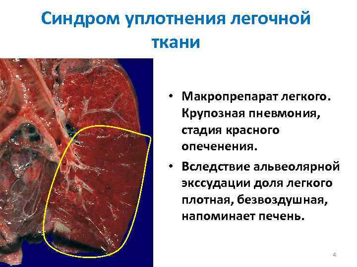 Синдром уплотнения легочной ткани • Макропрепарат легкого. Крупозная пневмония, стадия красного опеченения. • Вследствие