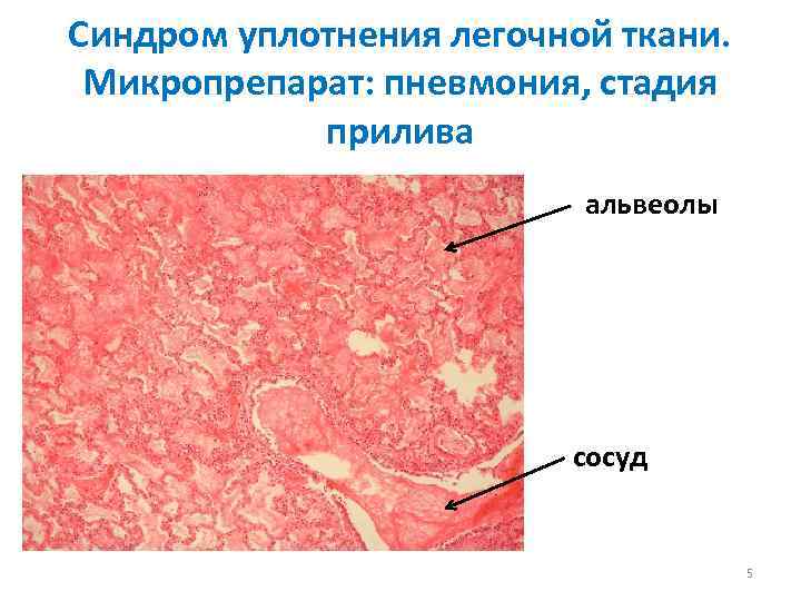 Синдром уплотнения легочной ткани. Микропрепарат: пневмония, стадия прилива альвеолы сосуд 5 