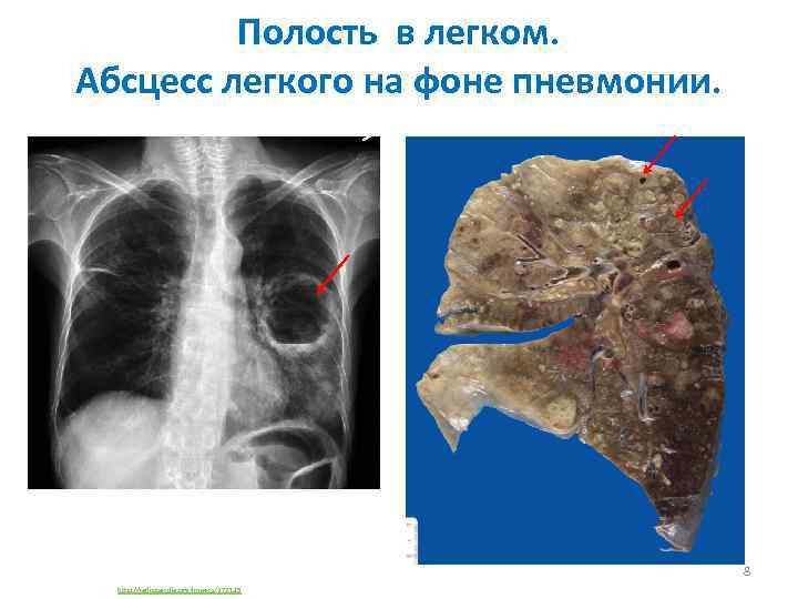 Полость в легком. Абсцесс легкого на фоне пневмонии. 8 http: //radiopaedia. org/images/272139 