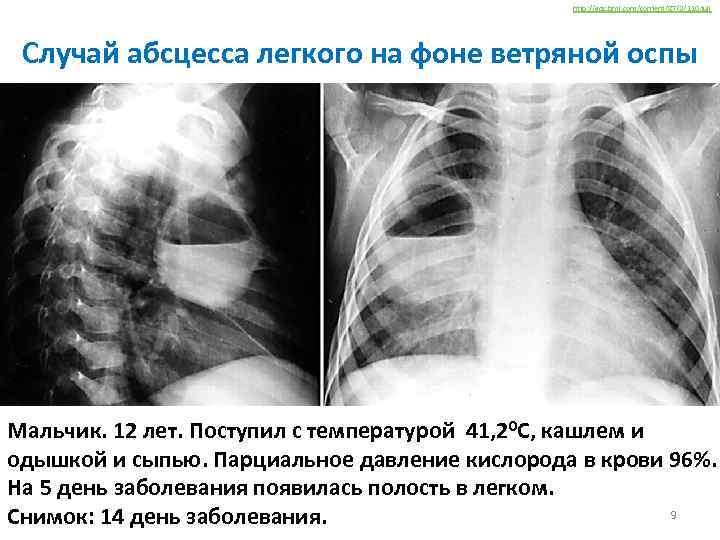 http: //adc. bmj. com/content/87/2/110. full Случай абсцесса легкого на фоне ветряной оспы Мальчик. 12