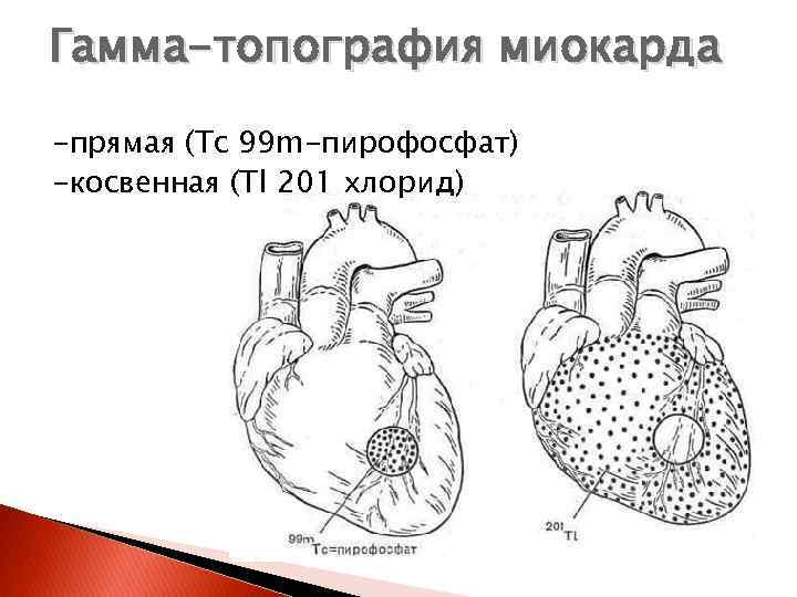 Гамма-топография миокарда -прямая (Тс 99 m-пирофосфат) -косвенная (Тl 201 хлорид) 