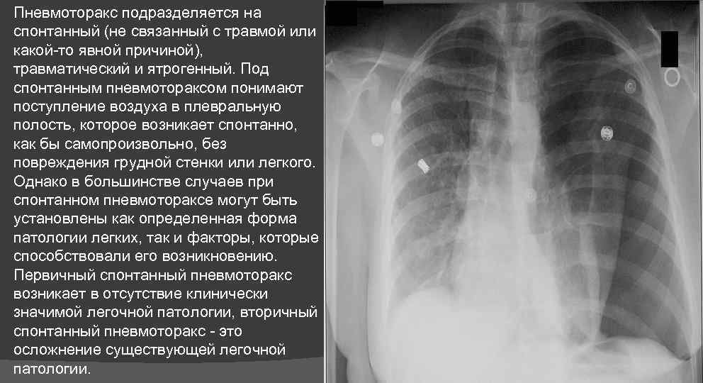 Спонтанный пневмоторакс карта вызова